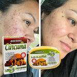 SERUM DE RETINOL - ANTIARRUGAS + REGALO JABON DE CURCUMA PARA EL ACNE