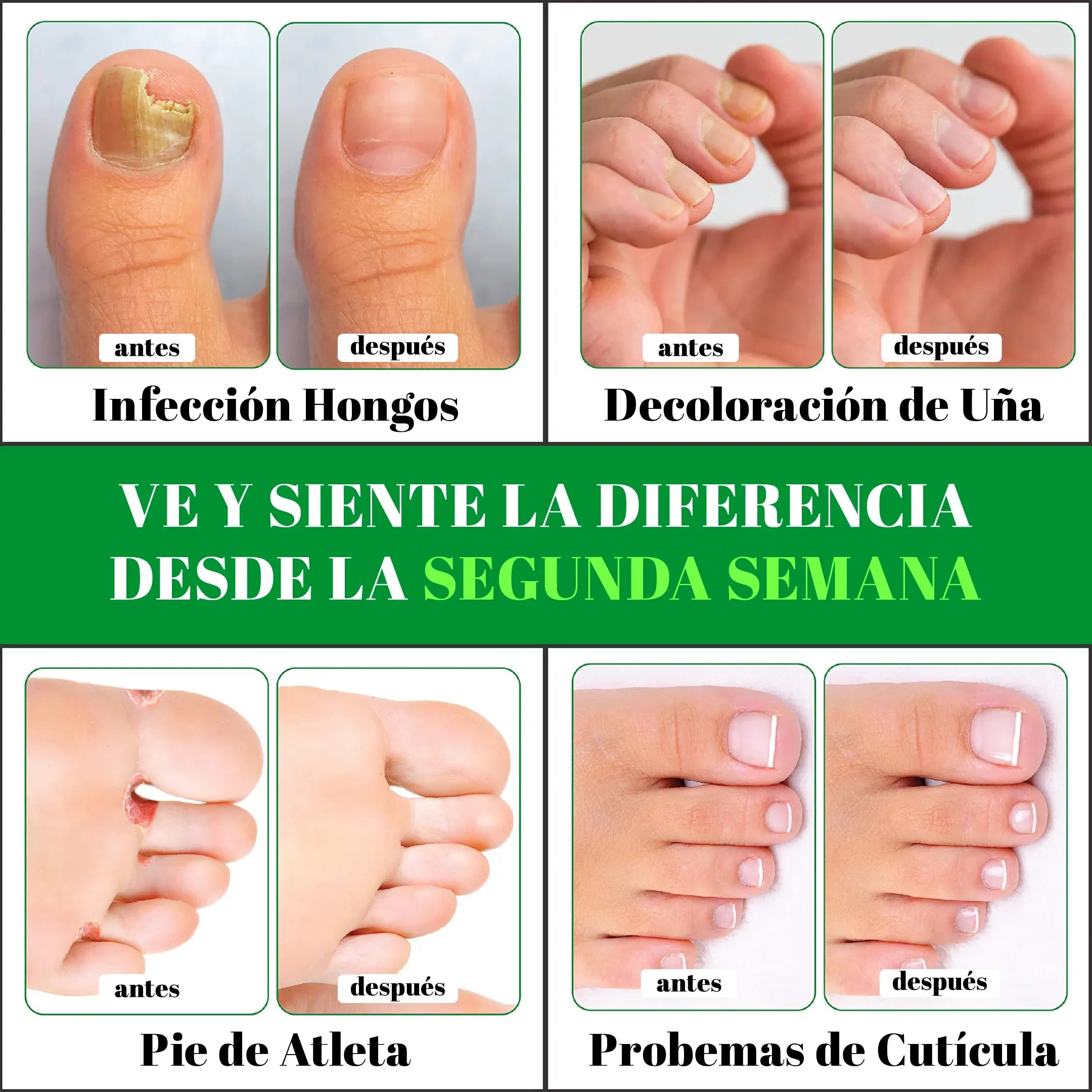 GOTAS DE TERBINAFINA PARA ELIMINAR LOS HONGOS