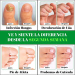 GOTAS DE TERBINAFINA PARA ELIMINAR LOS HONGOS